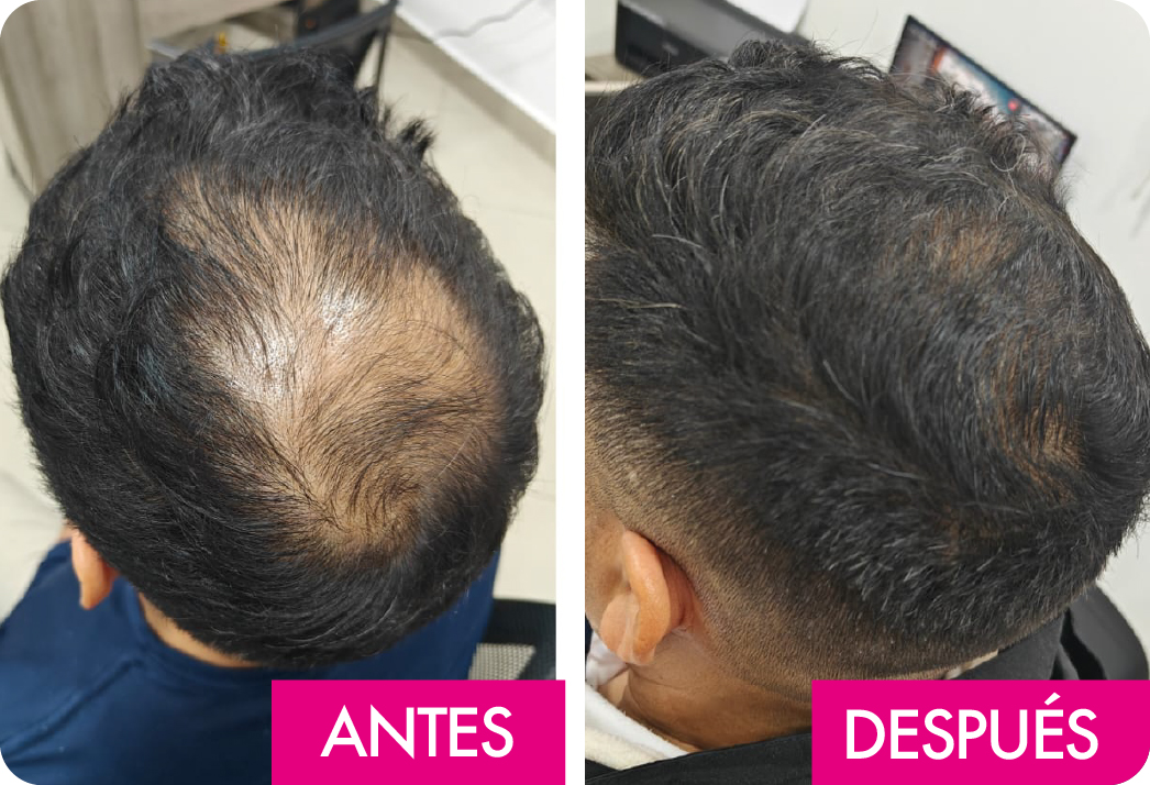 ALOPECIA