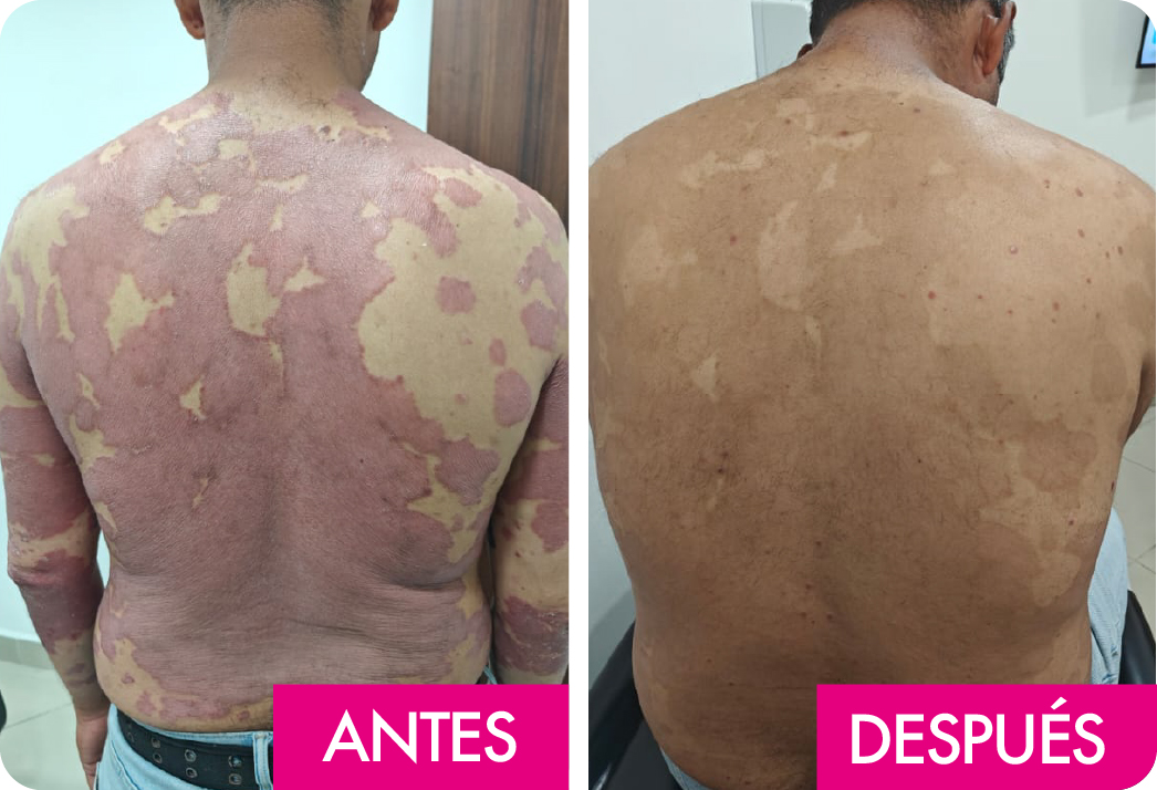 PSORIASIS