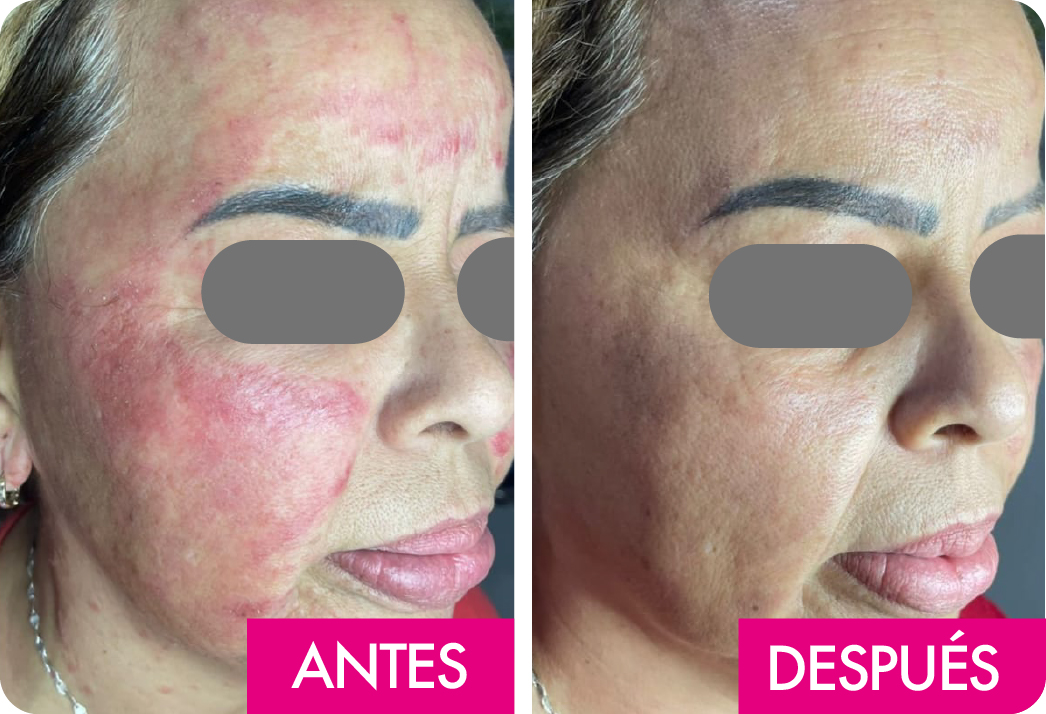 DERMATITIS
