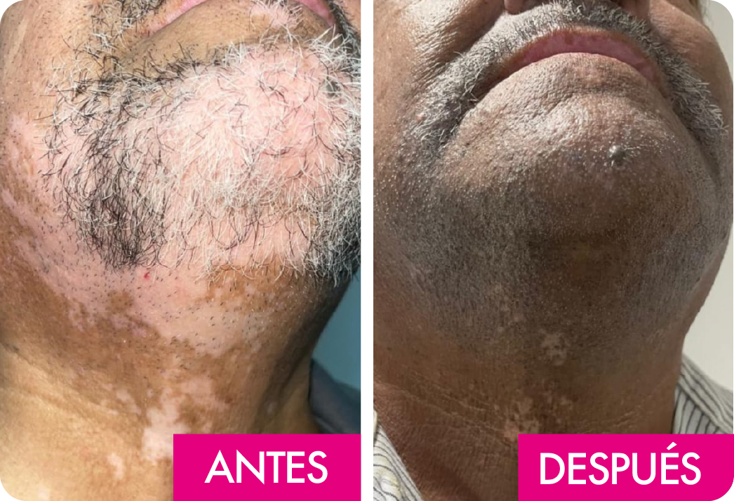 VITILIGO